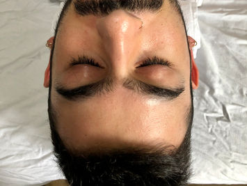 Before picture of Hydrodermabrasion facial June 2021