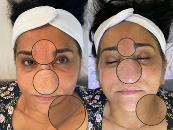 side-by-side before and after picture of the anti aging facial. 

Client saw instant improvements with the facial. Skin is hydrated, blackheads were removed and neck wrinkles are more firm. 

Book now for a firming glow