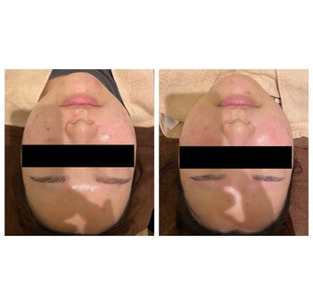 肌質改善。繰り返すニキビに終止符を