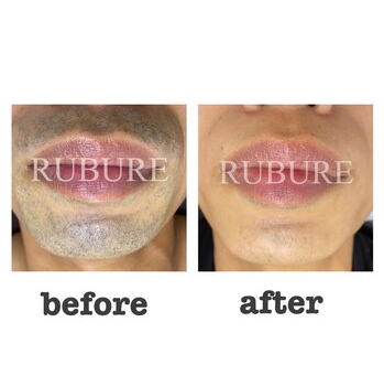 脱毛で毛穴が目立ちにくくなる仕組み