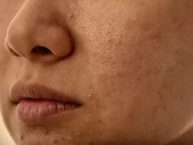 How to Get Rid of Textured Skin: The Treatments That Actually Work