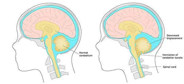 Chiari Malformation.png