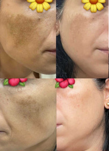 Cold Plasma image 1.jpeg