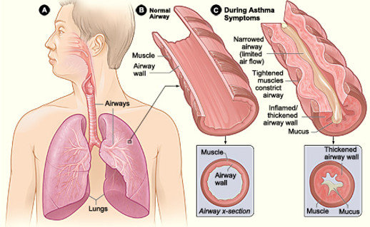 Asthma_attack-illustration_NIH[1].jpg