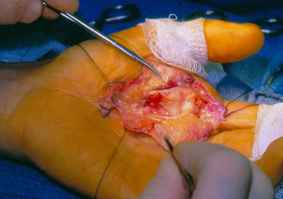 Hand Surgery