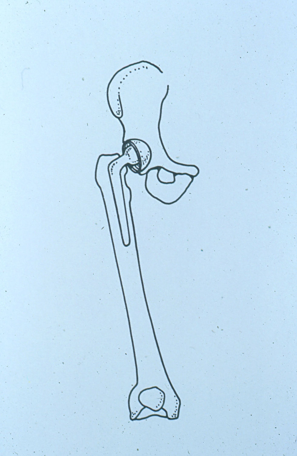 Hip Replacement Pin