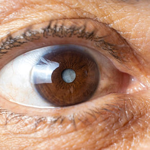 Quais são os sintomas comuns da catarata e quando buscar tratamento?