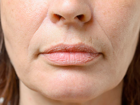 Ozempic Face: What You Need to Know About the Weight Loss Side Effect