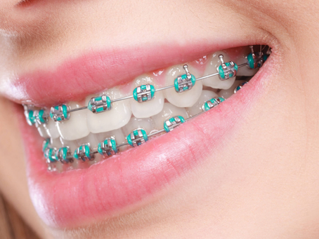 Pediatric Dentists Agree: Age X Is Best for Braces