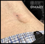 tragus, vertical tragus, f-skin, freaky skin, kartuzy, tatuaż, piercing, top 100 of poland, florida, piercing bible, sanepid, stowarzyszenie polskich piercerów, professional piercers poland, kolczyk, przekłucie, ucho, biżuteria, conch, lobe, industrial, helix, rook, septum, nostril, smiley, paoli, piercing, przekłuwanie, kolczyki, tytan, tatuaż, studio, Kartuzy, microdermal, dermal anchor, F-Skin, paoli, niemały, Kaszuby, Sierakowice, Stowarzyszenie Polskich Piercerów, Polish Piercers' Association