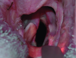Laryngeal paralysis treated with Tie-back surgery in dog