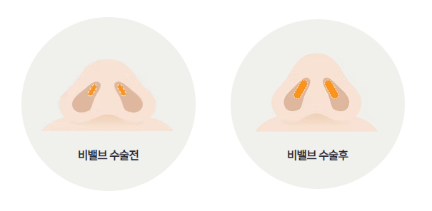 비밸브수술전후.png