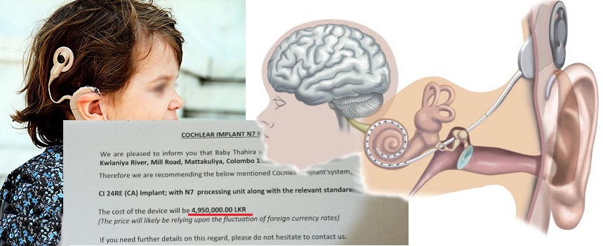 cochlear-implants-for-a-3-year-old