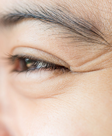 woman showing results of anti wrinkle injections