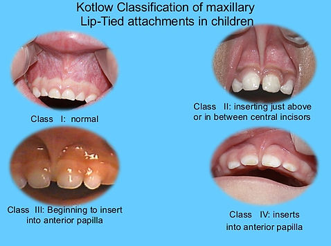 Kotlow Lip-Tie classifications.jpg