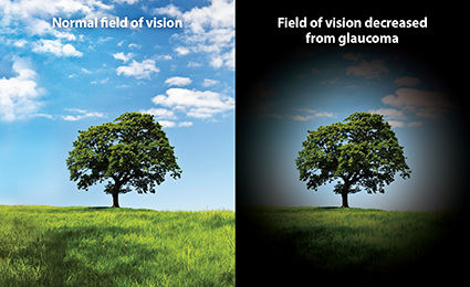 Fileld of vision