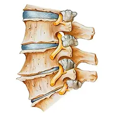 285x285_Osteoarthritis_Spine_What_Is_2.webp