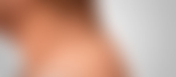 Bolinhas que parecem verrugas? Pode ser acrocórdons. 