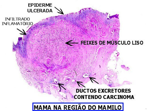 Paget de Mama, entenda.