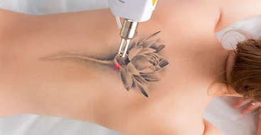 laser-tattoo-removal eliminación de tatuajes
