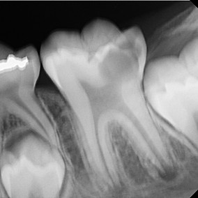 Pre-treatment periapical radiograph showing immature root development before direct pulp cap procedure in a young permanent tooth.