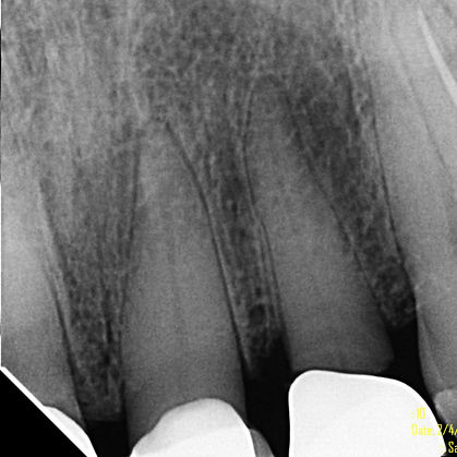 Periapical radiograph of anterior teeth showing root structure and bone levels, used for diagnostic comparison with Cone Beam CT imaging.