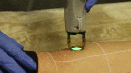laser-hair-removal-demonstration.gif