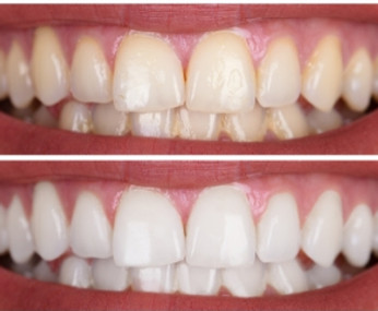 Zahnbleaching vorher, nachher Bild von Zähnen