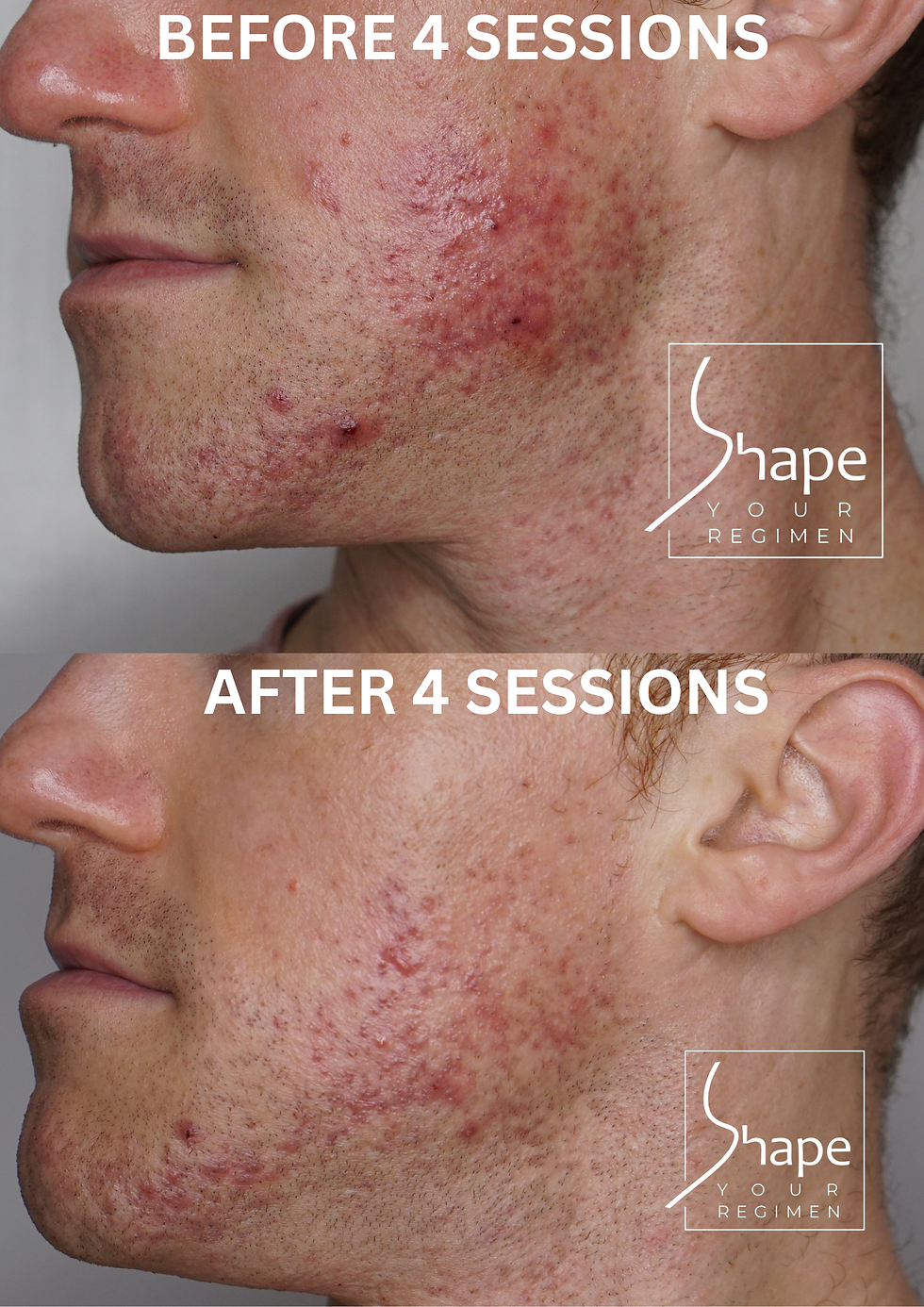 Hormonal Acne