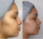 Acne and Post Inflammatory Hyperpigmentation