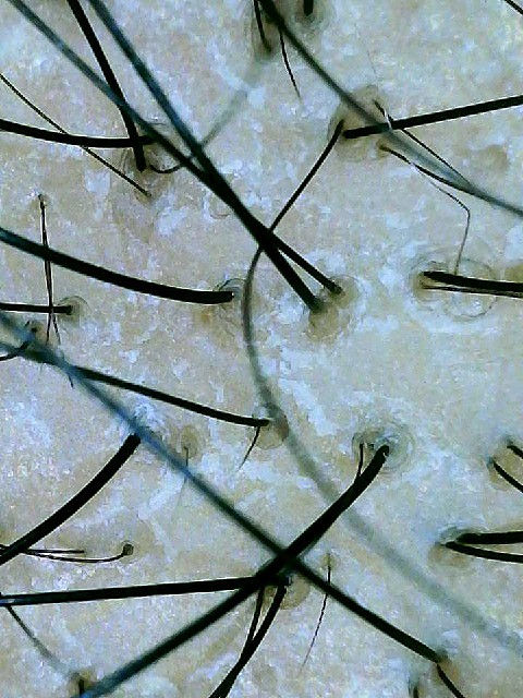 A magnified trichoscope view of a scalp and hair strands.