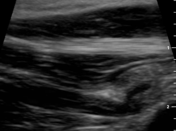 On-site musculoskeletal ultrasound uses high-frequency sound waves to create real-time images of muscles, tendons, ligaments and joints, helping diagnose sprains, tears, inflammation and nerve entrapments.