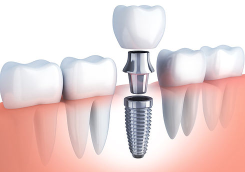 dental-implants.jpg