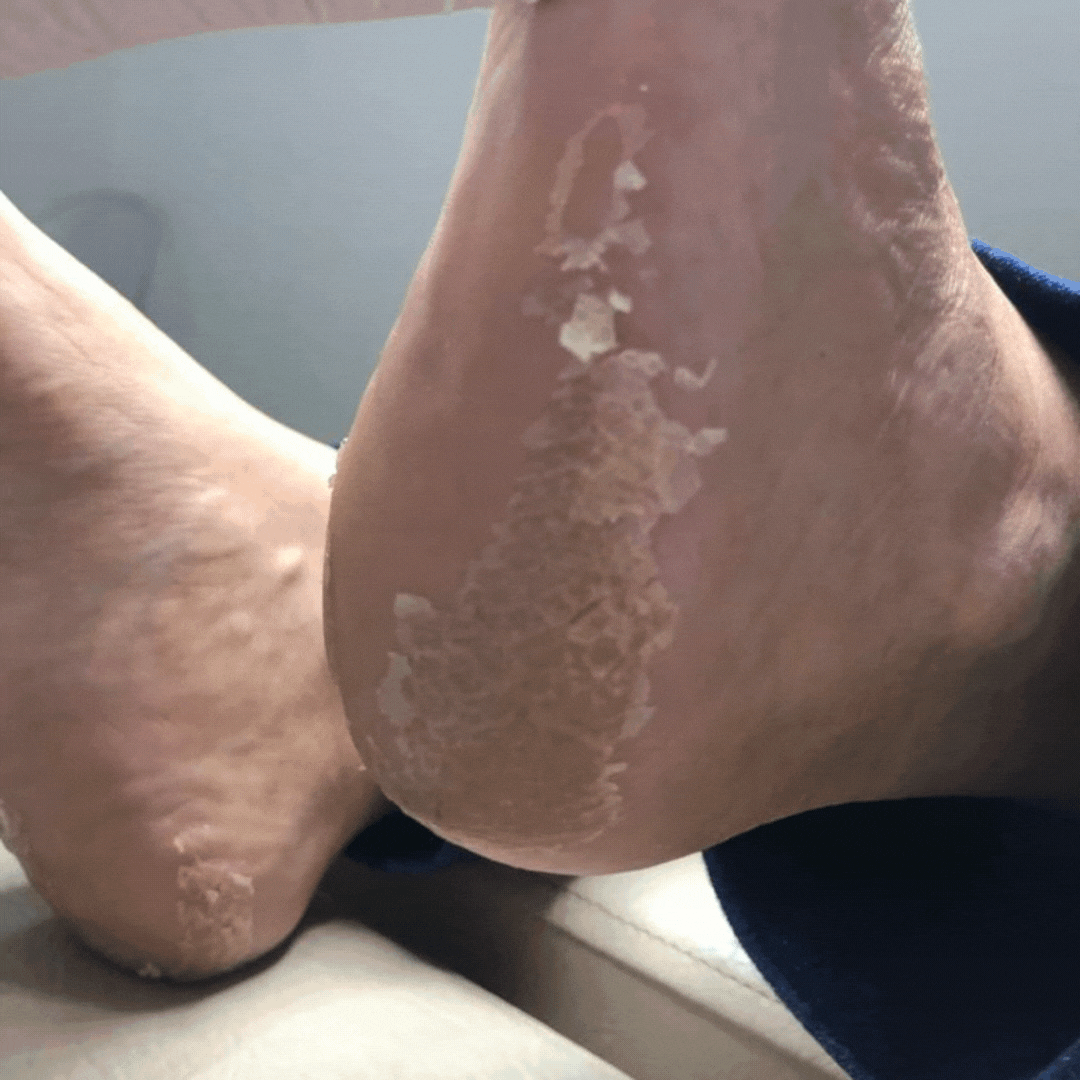 Peeling plantar