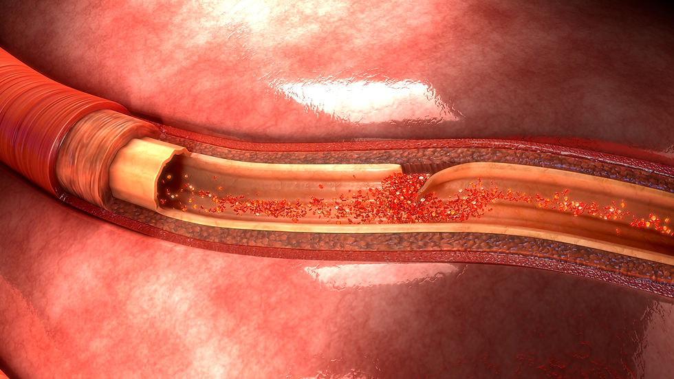 Cervical Artery Dissection