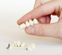 pont dentaire, dentiste, traitement dentaire, urgence dentiste, cabinet dentaire