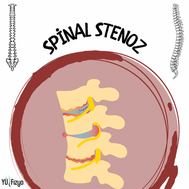 SPİNAL STENOZ