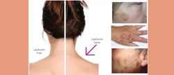 LIPOFUSCIN