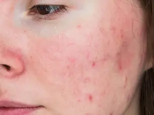 Problems With Rosacea And How Rejuvenated Supplements Can Help