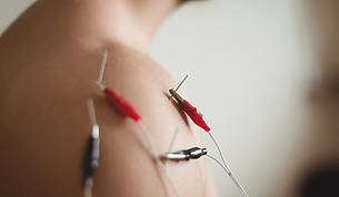 Eletro acupuntura