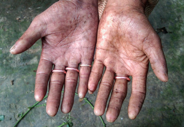 Does Everyone Have Fingerprints? - NO? content media