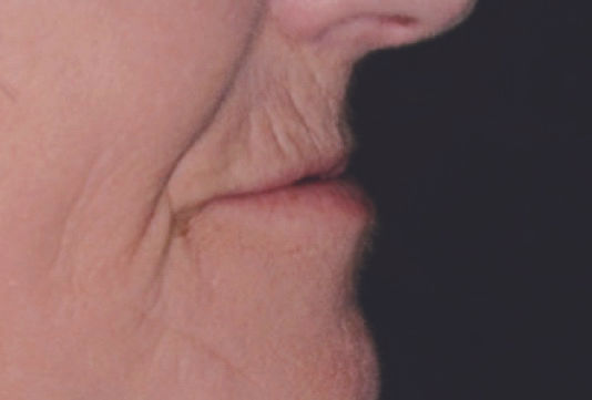 1. 심미성 저하