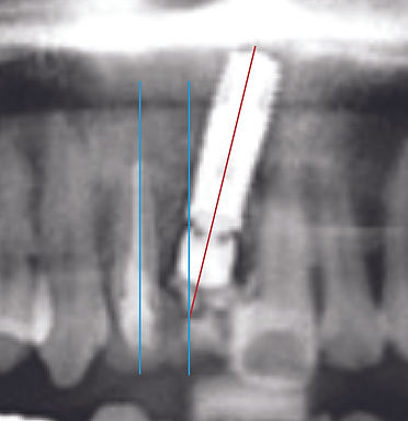 기존 임플란트 시술 x-ray.jpg