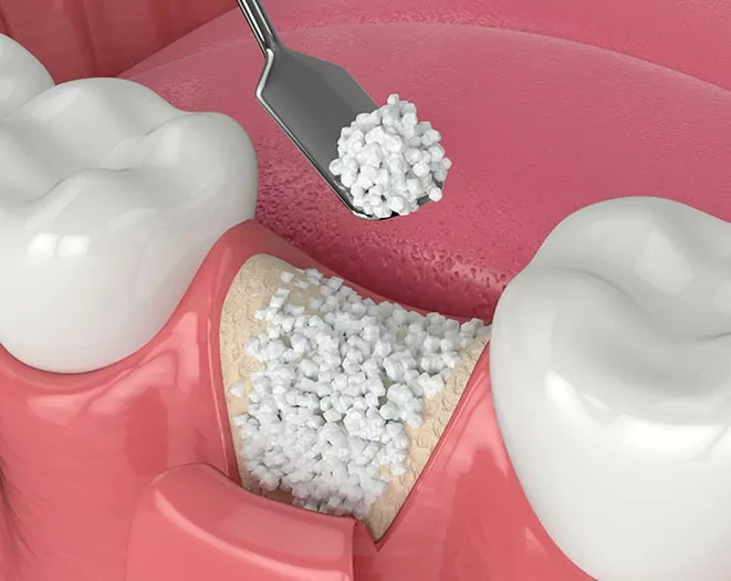 bone-grafting.webp