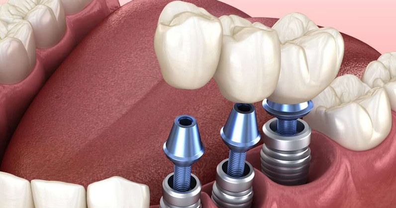 Dental-Implants-ft.jpeg