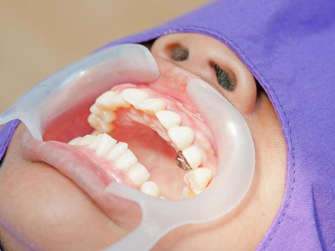 person-at-dentist-with-mouth-pried-open.jpeg