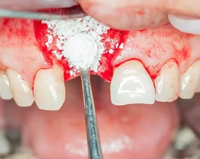 bone-grafting-e1586481972638.webp