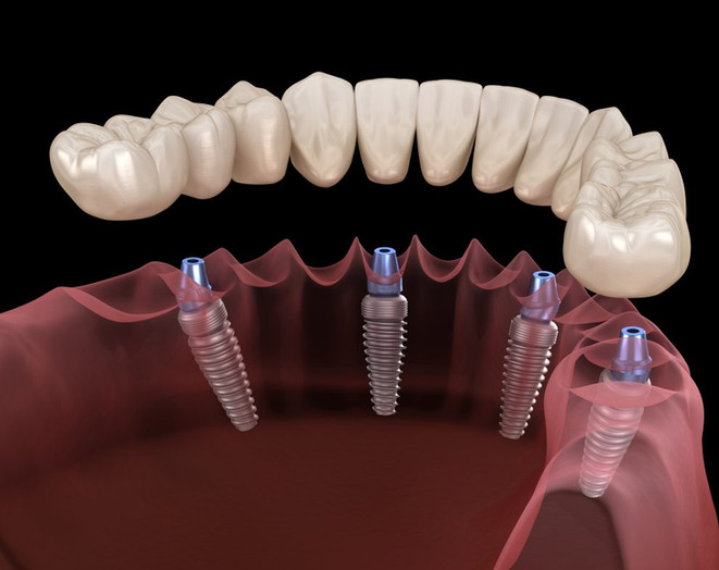 all-on-4-dental-implants-ventura-3.jpeg