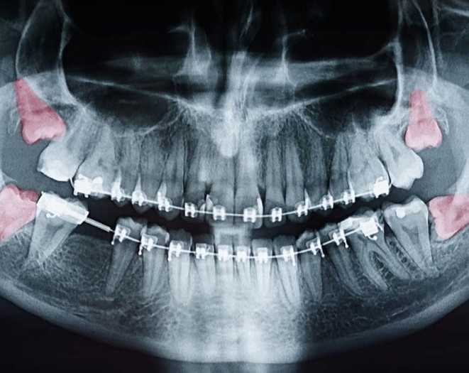 MonitoringWisdomTeeth-1024x683.jpeg