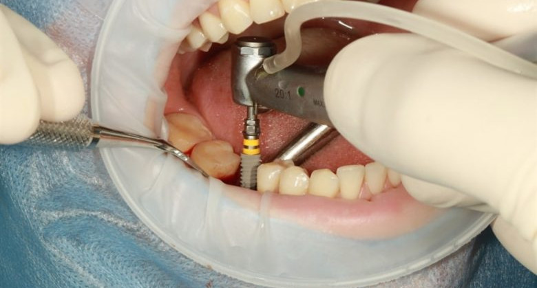 What-Are-Dental-Implants-Made-Of-780x520-1.jpeg